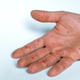 Image for article titled Monkeypox Is Continuing to Surge Across the U.S.